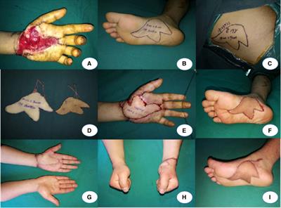 Reconstruction of the Palmar Defect of the Hand with a Sensory Medial Plantar Artery Flap